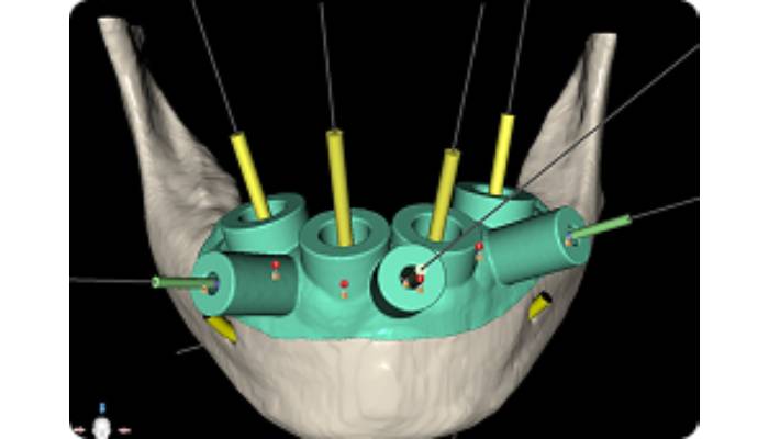 3D printer for implant surgical guide 